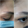 Laser Tattoo Removal-F.Houshidari,MD_70
