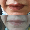 Laser Tattoo Removal-F.Houshidari,MD_72