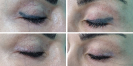 Laser Tattoo Removal-F.Houshidari,MD_74