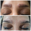 Laser Tattoo Removal-F.Houshidari,MD_75
