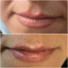 Laser Tattoo Removal-F.Houshidari,MD_77