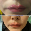 Laser Tattoo Removal-F.Houshidari,MD_7