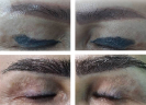 Laser Tattoo Removal-F.Houshidari,MD_80