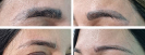 Laser Tattoo Removal-F.Houshidari,MD_81