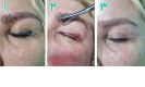 Laser Tattoo Removal-F.Houshidari,MD_82