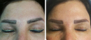 Laser Tattoo Removal-F.Houshidari,MD_8
