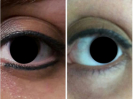 Laser Tattoo Removal-F.Houshidari,MD_9