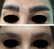 Tattoo Removal_1