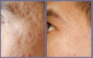 Mole , Scar and ... Removal
