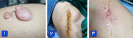 Skin Lumps and Cysts Removal_1