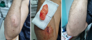 Skin Lumps and Cysts Removal