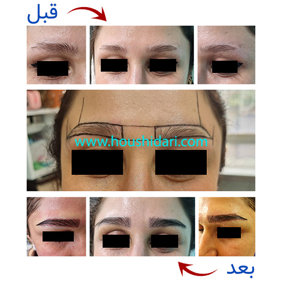 کاشت ابروی طبیعی