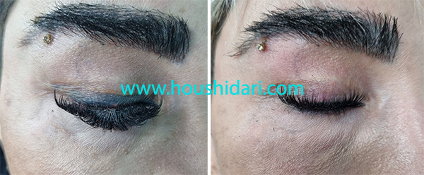 پاک شدن خط چشم در یک جلسه با جراحی لیزری