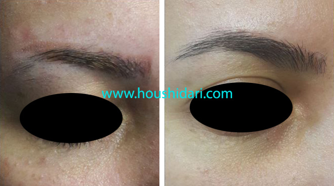 پاک کردن تاتوی ابرو در یک جلسه