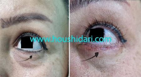 ریموو خط چشم در یک جلسه