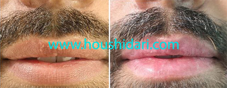 پاک کردن تاتو لب آقایان