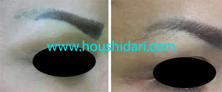 پاک کردن تاتو ابرو در یک جلسه