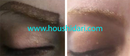 پاک کردن تاتو ابرو در یک جلسه