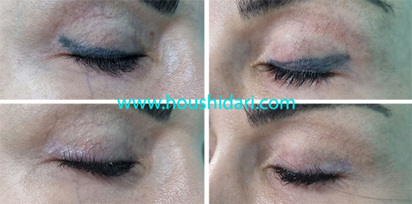 پاک کردن تاتو(تتو) خط چشم در یک جلسه و نتیجه بعد از یکماه