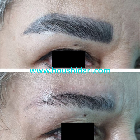 پاک شدن تتو ابرو فقط در یک جلسه با لیزر