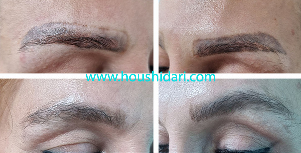 نمونه ریمو لیزری تتو ناهماهنگ ابروها فقط در یک جلسه