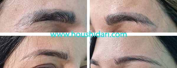 نمونه دیگری از ریمو تک جلسه ای تتو ابرو با لیزر در کلینیک میرداماد