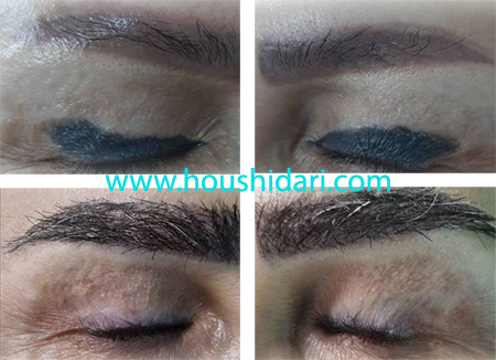 ریمو تاتو خط چشم و تاتو ابرو در یک جلسه و سپس کاشت ابرو