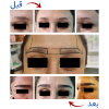 کاشت ابرو-دکتر فرهاد هوشیدری