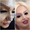 برداشتن خال، زگیل و هرگونه آثار زخم، اسکار جراحی و سوختگی