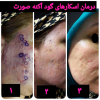 برداشتن خال ، زگیل و هرگونه آثار زخم ، اسکار جراحی و سوختگی_1
